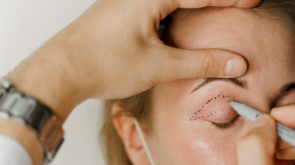 Nahaufnahme einer ärztlichen Untersuchung im Rahmen einer Blepharoplastik oder Augenlidstraffung, bei der die Stirn der Patientin gehalten wird, um mit dem Stift eine Linie zu markieren.